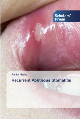 Recurrent Aphthous Stomatitis