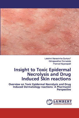 Insight to Toxic Epidermal Necrolysis and Drug Induced Skin reactions