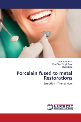 Porcelain fused to metal Restorations