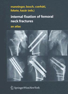 Internal fixation of femoral neck fractures : An Atlas